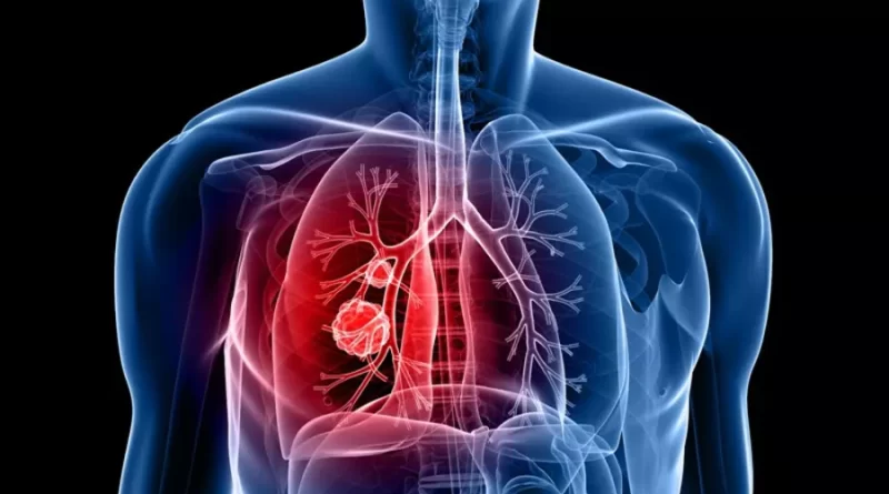 lung cancer treatment