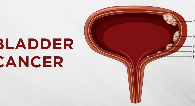 Understanding the Gender Differences in Bladder Infections