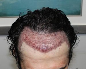 Hair Transplant Clinic in Indore